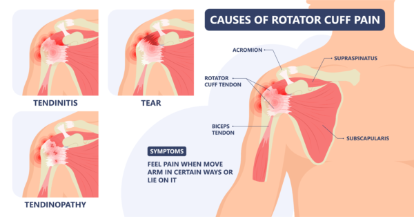 Rotator Cuff Tendinopathy Symmetry Physiotherapy rotator-cuff-tendinopathy-symmetry-physiotherapy