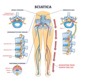 Diagram of sciatica pain